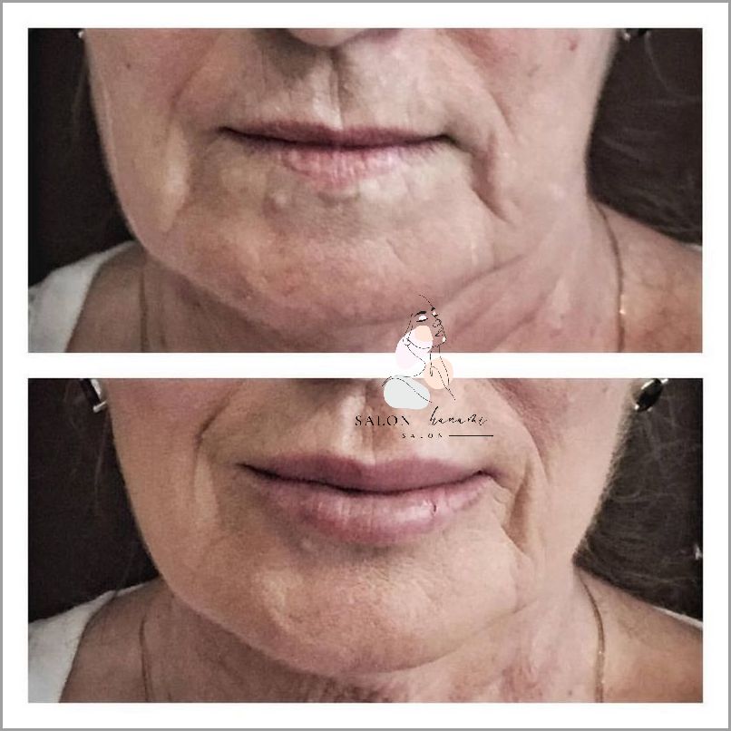 Powiększanie Ust Na Plasko - Sprawdź!