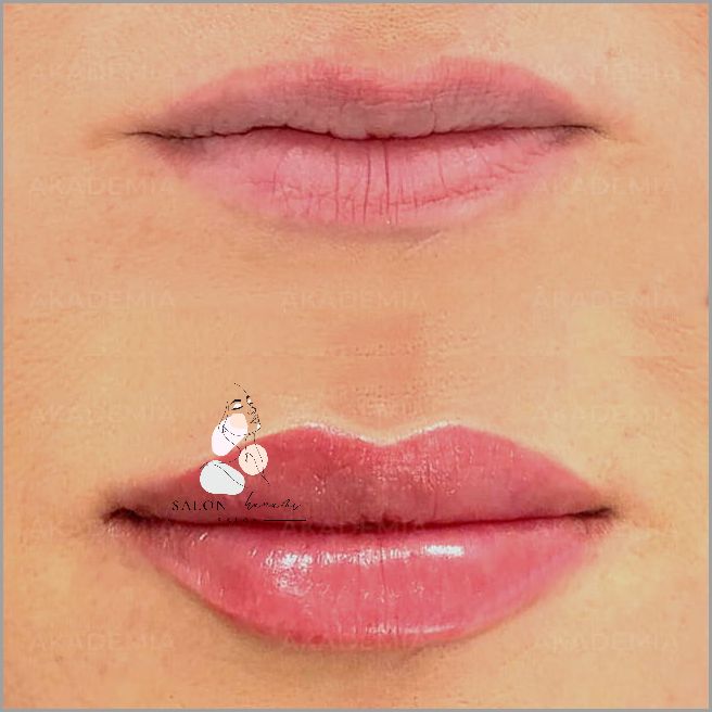 Powiększanie Ust Na Plasko - Sprawdź!