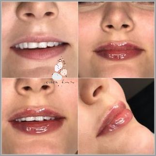 Powiększanie Ust Na Plasko - Sprawdź!