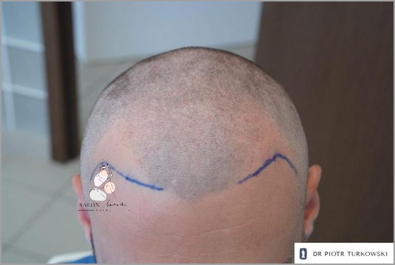 Rozwiązanie Na Zapalenie Mieszków Włosowych: Tribiotic!