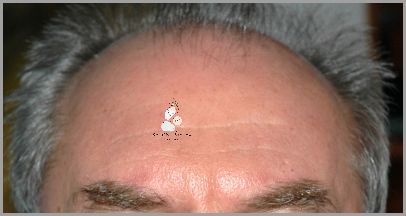 Skuteczne Wcierki Na Łysienie Androgenowe!