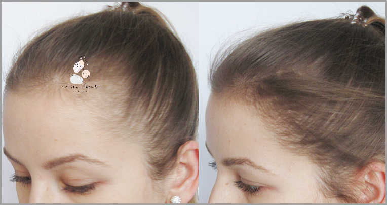 Skuteczne Wcierki Na Łysienie Androgenowe!