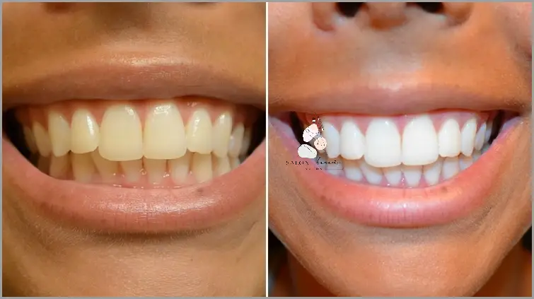 Skuteczny Sposób na Białe Zęby: Czym Wybielić Zęby?