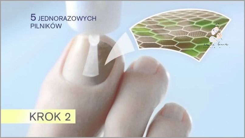 Szokujące! Wyleczyłam Grzybicę Paznokci - Forum
