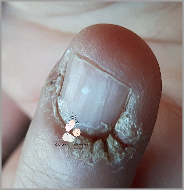 Tajemnice Suchych Paznokci Wokół Skóry!