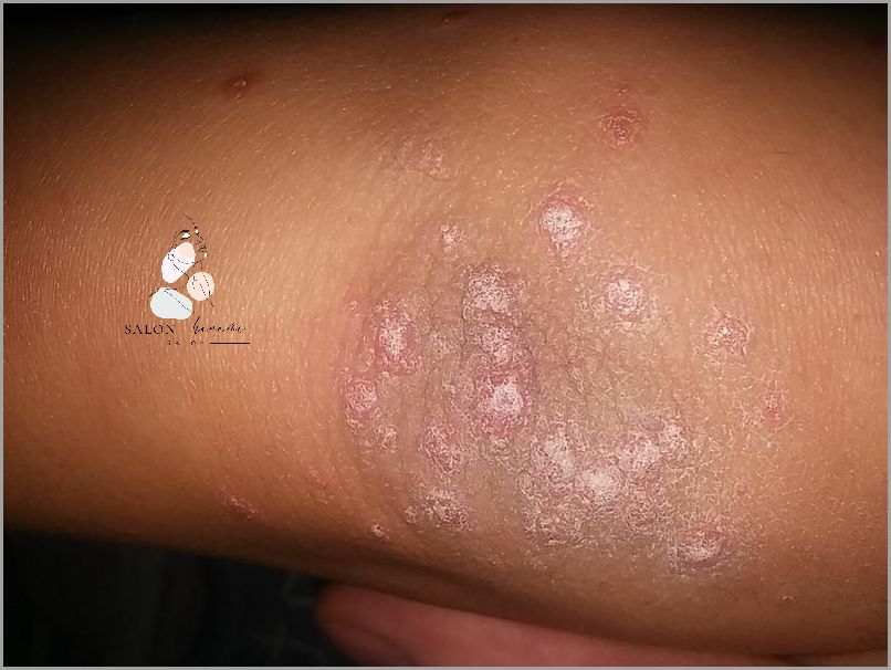 U Twojego Dziecka Pojawiły Się Krosty Na Ramionach?!