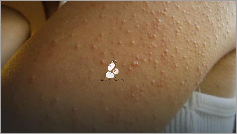 U Twojego Dziecka Pojawiły Się Krosty Na Ramionach?!