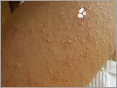 U Twojego Dziecka Pojawiły Się Krosty Na Ramionach?!