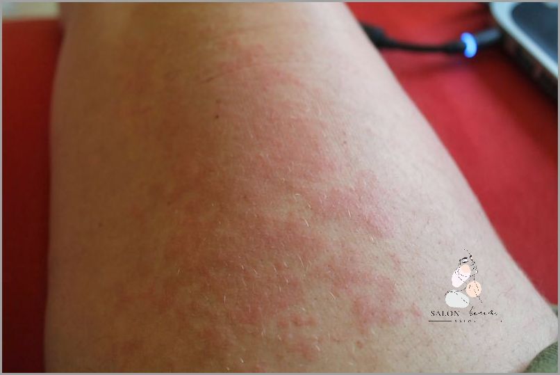 U Twojego Dziecka Pojawiły Się Krosty Na Ramionach?!