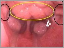 Uderzający Ból Gardła I Ucha - Co Oznacza Jednostronny?