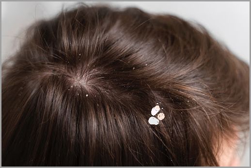 Ujarzmij Suchą Skórę Głowy Strupki!