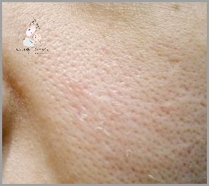 Ujawniamy: Rozszerzone Pory Jak Wyglądają!