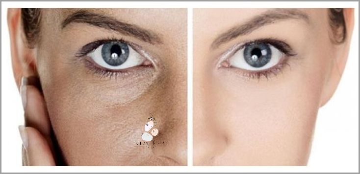 Ujędrzające Zabiegi Na Rozszerzone Pory!