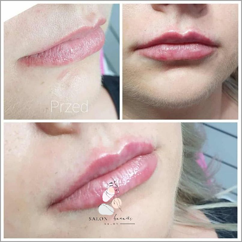 Usta 0 5 Ml - Niesamowite Efekty! Usta 0 5 Ml - Niesamowite Efekty!