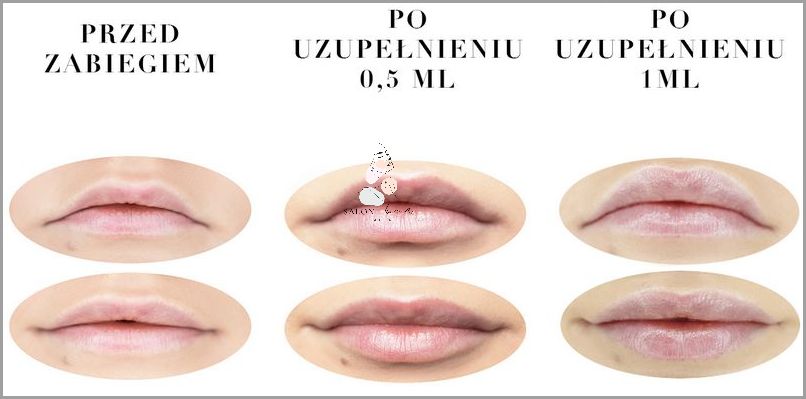 Usta 0 5 Ml - Niesamowite Efekty! Usta 0 5 Ml - Niesamowite Efekty!