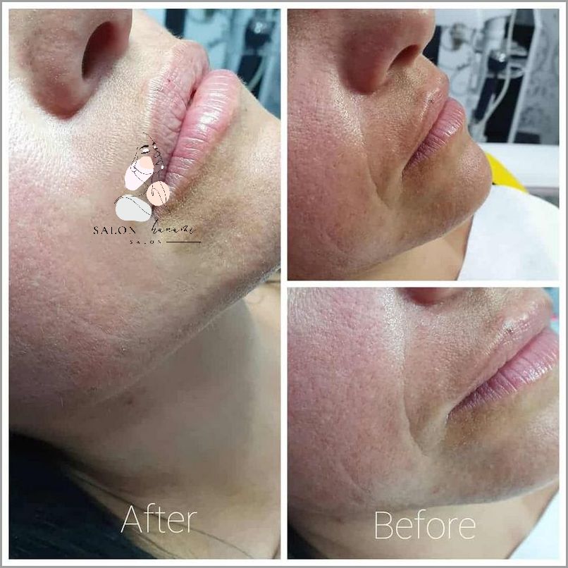 Usta 0 5 Ml - Niesamowite Efekty! Usta 0 5 Ml - Niesamowite Efekty!