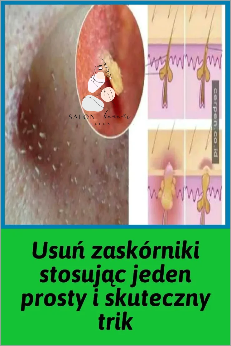 Usuń Zaskórnikiki z Przyrządem Do Usuwania Zaskórników!