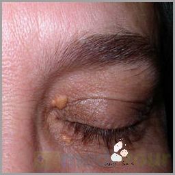 Uwaga! Żółte Plamy Pod Pachami Są Groźne!