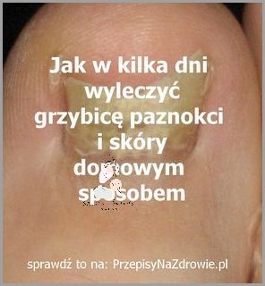 Zaskakująca Przyczyna Przebarwień Paznokci U Nóg! Zaskakująca Przyczyna Przebarwień Paznokci U Nóg!