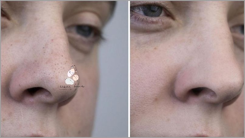 Zaskakujące Efekty Zelu z Kwasem Salicylowym!