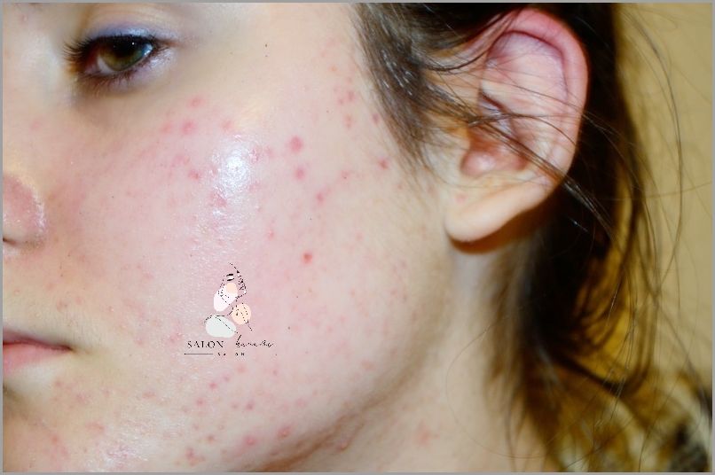 Zaskakujące Efekty Zelu z Kwasem Salicylowym!