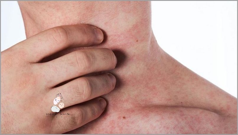 Zobacz Zdjęcia: Jak Wygląda Wysypka Przy Ząbkowaniu! Zobacz Zdjęcia: Jak Wygląda Wysypka Przy Ząbkowaniu!