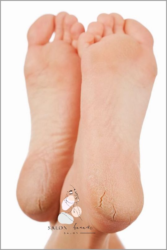 10 Skutecznych Sposobów na Popękane Pięty!