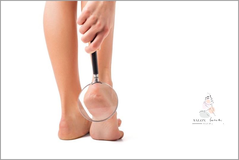 10 Skutecznych Sposobów na Popękane Pięty!