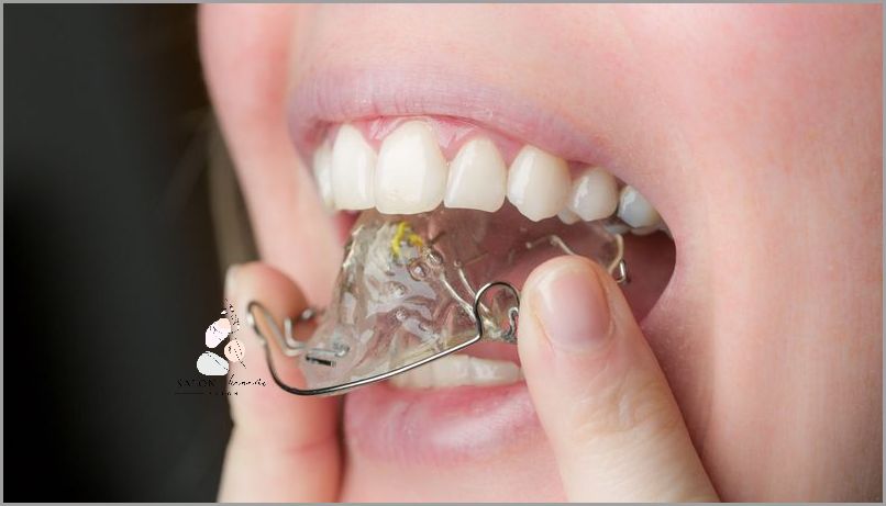 Aparat Samoligaturujący Przed I Po - Sprawdź, jak zmienia zęby!