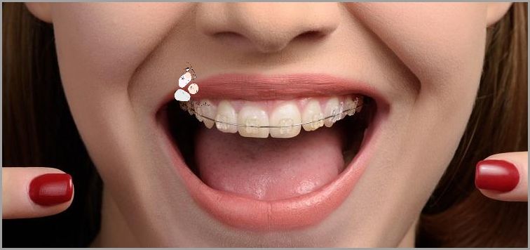 Aparat Samoligaturujący Przed I Po - Sprawdź, jak zmienia zęby!