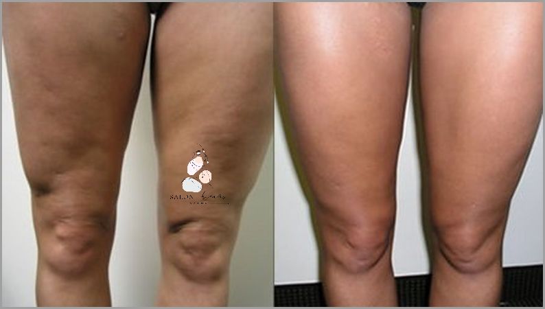 Cudowny Peeling Z Kawy Na Cellulit!