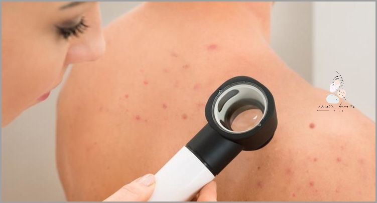 Czerniak pod Paznokciem - Niedoceniany Zagrożenia!