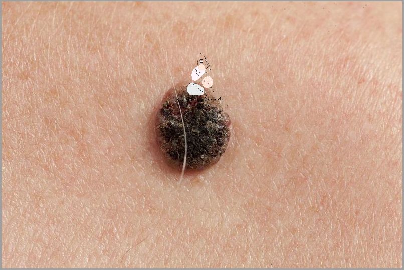 Czerniak pod Paznokciem - Niedoceniany Zagrożenia!