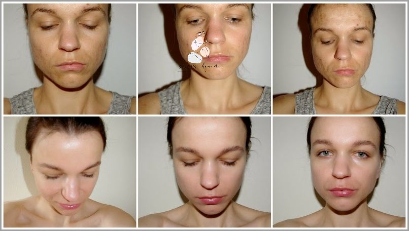 Efekty Uboczne Odżywek Proteinowych Do Włosów!