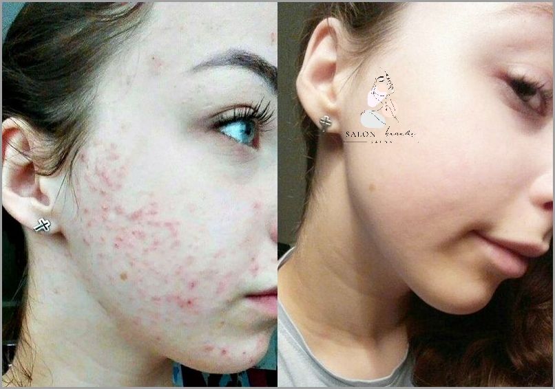 Efekty Uboczne Odżywek Proteinowych Do Włosów!