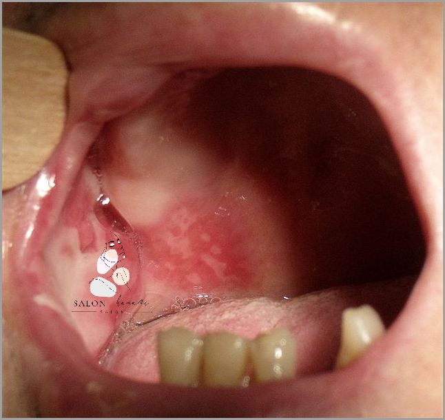 Forum: Leczenie Zapalenia Jamy Ustnej!