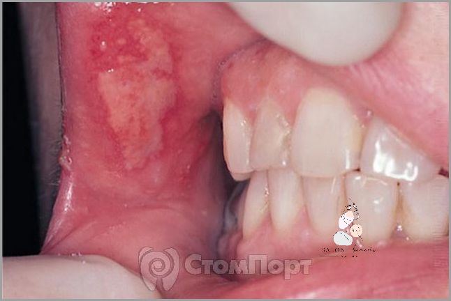 Forum: Leczenie Zapalenia Jamy Ustnej!