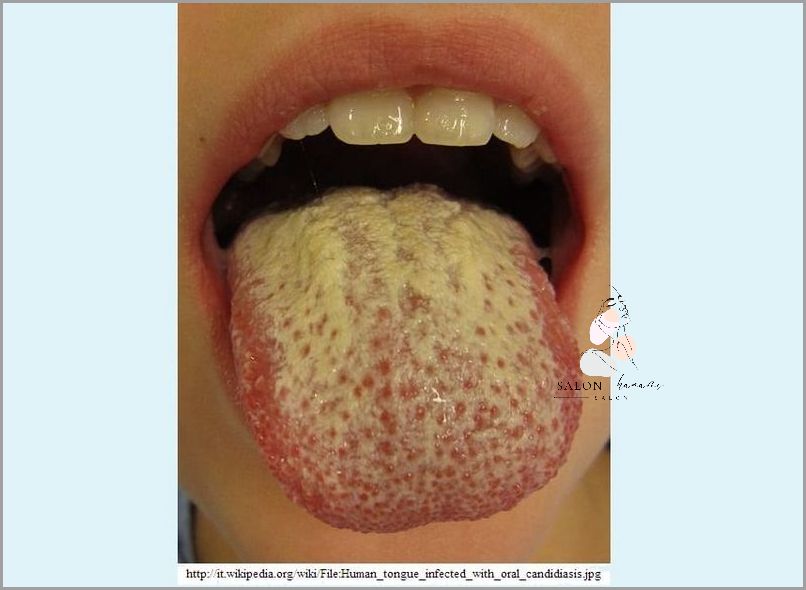 Forum: Leczenie Zapalenia Jamy Ustnej!