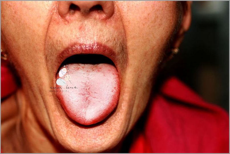 Forum: Leczenie Zapalenia Jamy Ustnej!