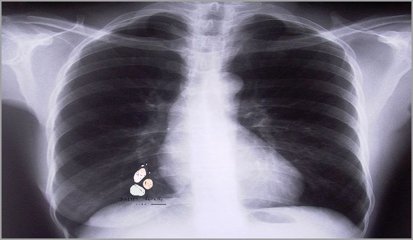 Forum o Umieraniu na Rak Płuc.