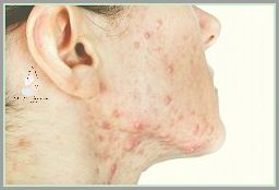 Gronkowiec Złocisty w Gardle! Co to oznacza?