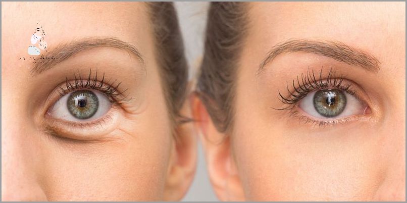 Jak Pozbyć Się Opuchniętych Oczu Po Nocy?