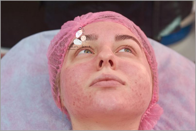 Jak Pozbyć Się Rumienia na Twarzy?