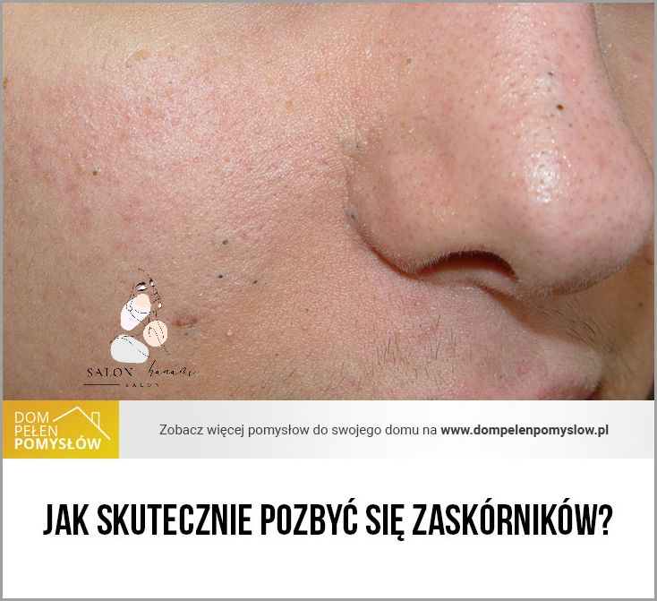 Jak pozbyć się strupów? Jak pozbyć się strupów?