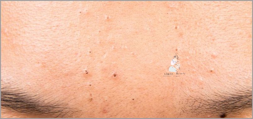 Jak Pozbyć Się Zaskórników Zamkniętych? Jak Pozbyć Się Zaskórników Zamkniętych?