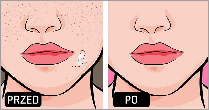 Jak Pozbyć Się Zaskórników Zamkniętych? Jak Pozbyć Się Zaskórników Zamkniętych?