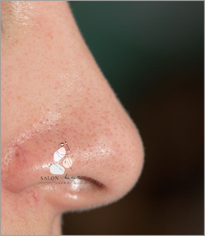 Jak Pozbyć Się Zaskórników Zamkniętych? Jak Pozbyć Się Zaskórników Zamkniętych?