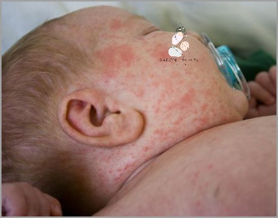 Jak Rozpoznać Potówki U Niemowlaka? Dowiedz Się!