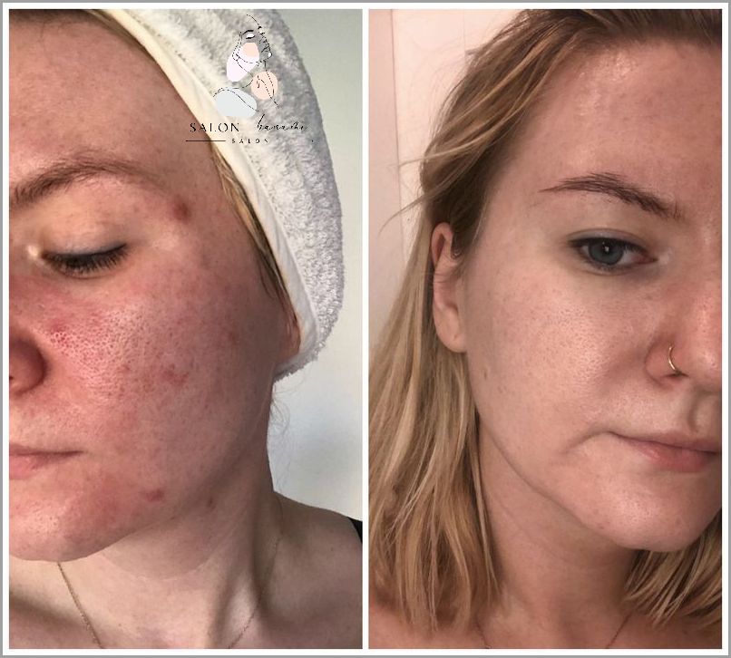 Jak Się Pozbyć Wąsika?