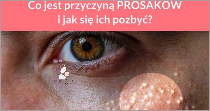 Jak Się Pozbyć Wąsika?
